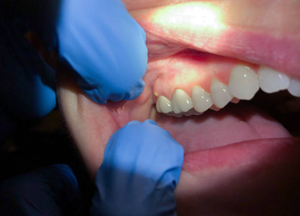 Best Emergency Dentist for Lost Fillings or Crowns in Bellflower, CA
